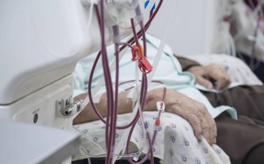 Ekipmanlardaki insanlarda hemodiyaliz