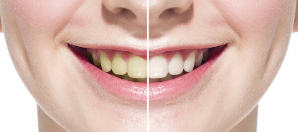 Bleaching of teeth. Before and after.