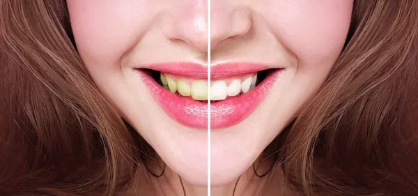 Blanqueamiento Dientes Antes Después — Foto de Stock