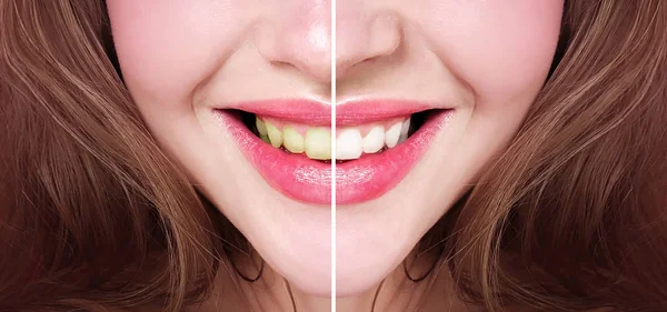 Відбілювання Зубів Після Ліцензійні Стокові Фото