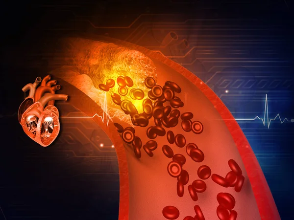 Artérias Obstruídas Com Coração Humano Ataque Cardíaco Ilustração — Fotografia de Stock