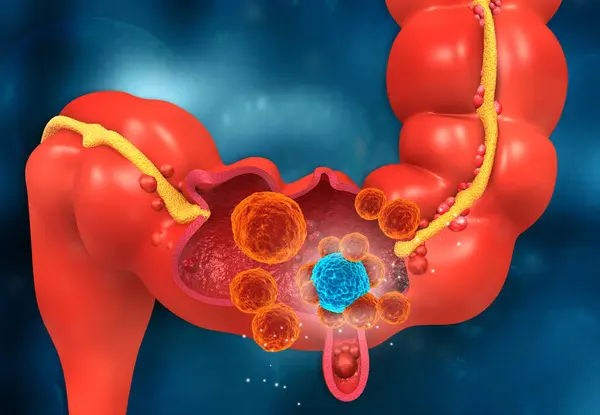 Рак Толстой Кишки Концепция Вирусной Инфекции Иллюстрация — стоковое фото