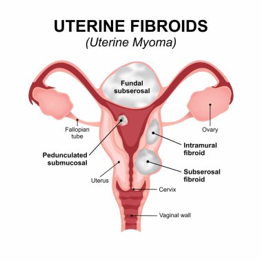 Rahim fibroidi - uterin miyoma medikal hafıza kartı çizimi
