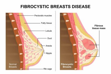 Fibrokistik Göğüs Hastalığı Flashcard İllüstrasyonu