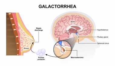 Galaktorrhea hafıza kartı göğüs ve beyin çizimleri