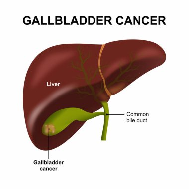 Safra kesesi kanseri, karaciğer flaş kartı çizimi