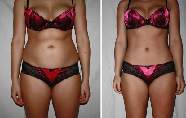 Authentic real amateurish before and after weight loss photo of female body. — Stock Photo, Image