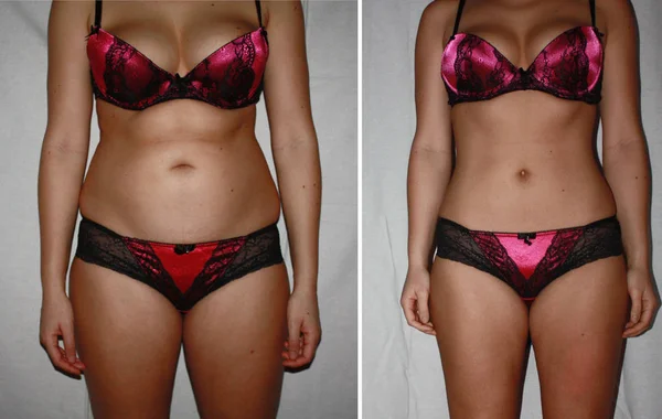 Автентичний реальний любитель до і після схуднення фото жіночого тіла . Стокове Фото