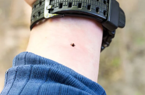 Teek Bijt Zijn Hand Mijt Onder Huid Hand Van Mens — Stockfoto