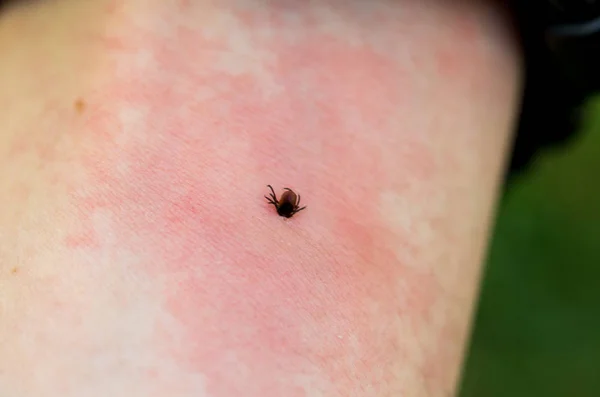 Irritatie Van Beet Roodheid Huid Van Een Tekenbeet Een Gevaarlijke — Stockfoto