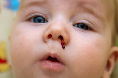 Close up image of the runny, bloody nose of a baby boy two days after his four month vaccines.  Adverse reaction to the PCV vaccine.  clipart