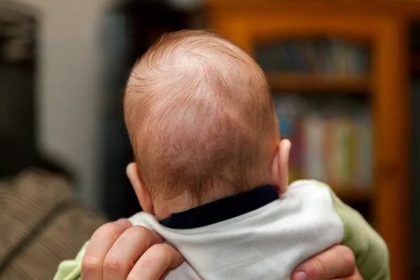 The back of a head of a baby who had just received a possibly diagnosis of Craniosynostosis.  You can see where his cranial plates are overlapping into ridges.