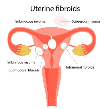 Rahim fibroidlerinin vektör çizimi. 