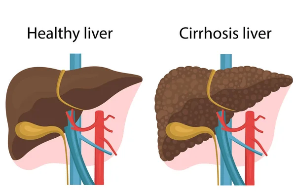 Cirrosis del hígado — Vector de stock