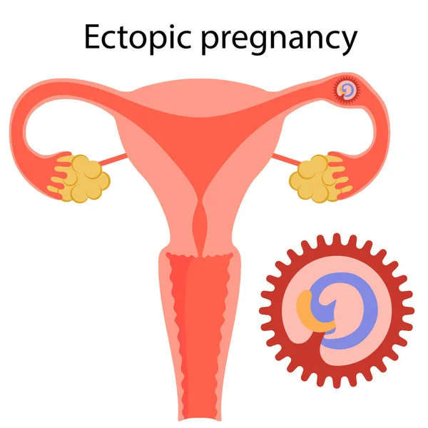 Buitenbaarmoederlijke zwangerschap. Complicatie. — Stockvector