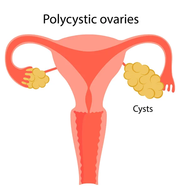 Llustration av polycystiska äggstockar — Stock vektor