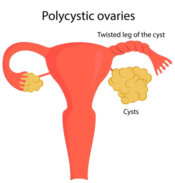 Zkroucená noha cysty — Stockový vektor