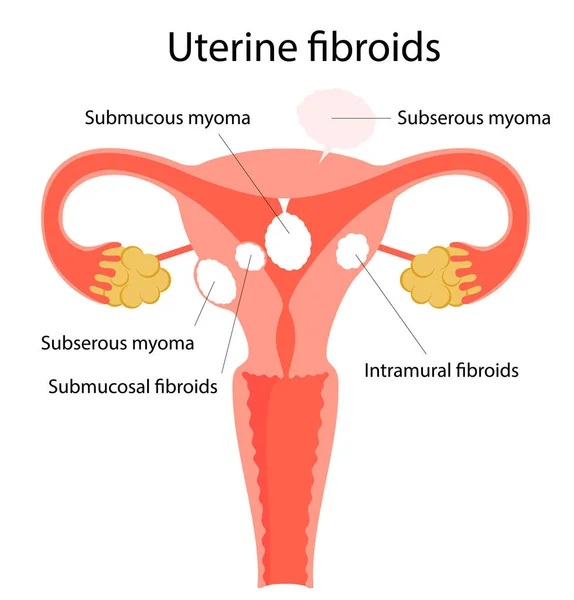 Illustrazione vettoriale dei fibromi uterini. — Vettoriale Stock