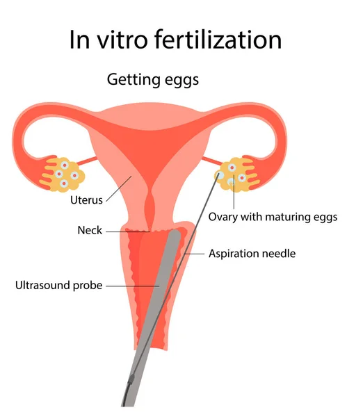 Ilustración fertilización in vitro — Vector de stock