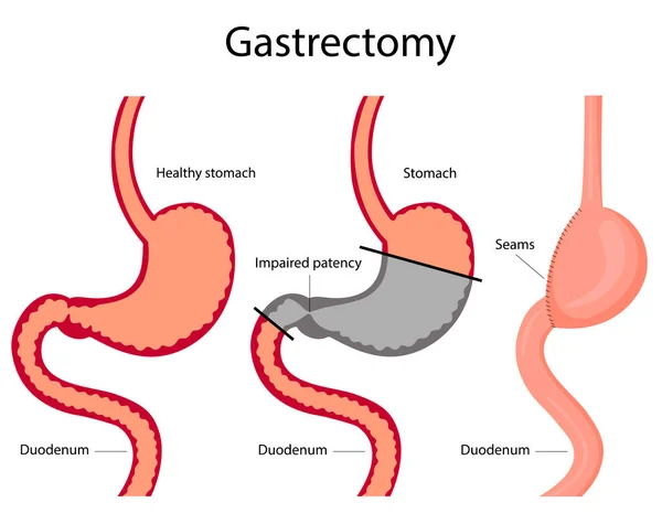 Wektorowa ilustracja gastrektomii. Ilustracja Stockowa