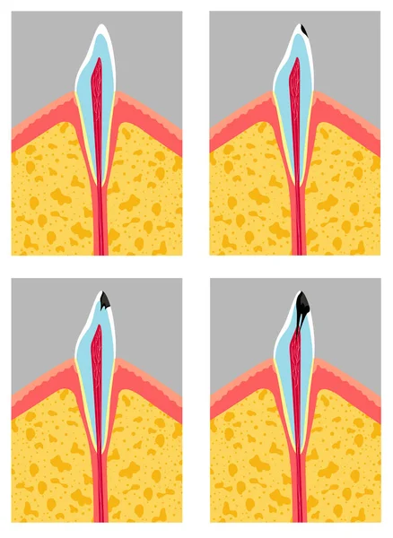 Étapes de la carie dentaire — Image vectorielle