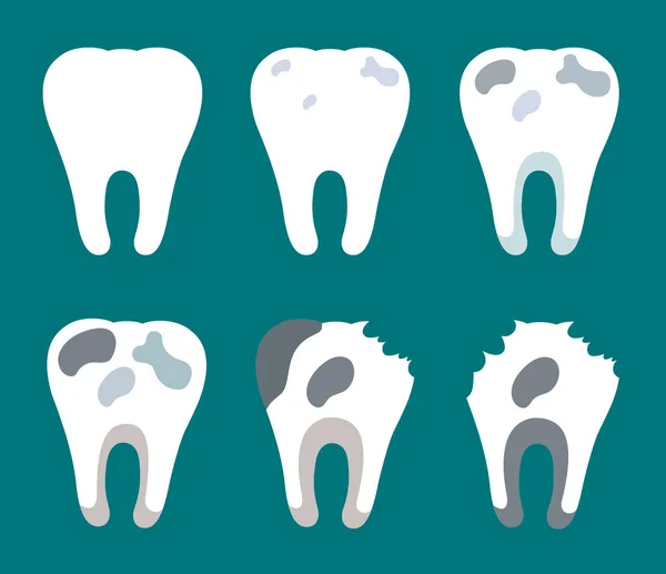 Etapas de caries dental — Vector de stock