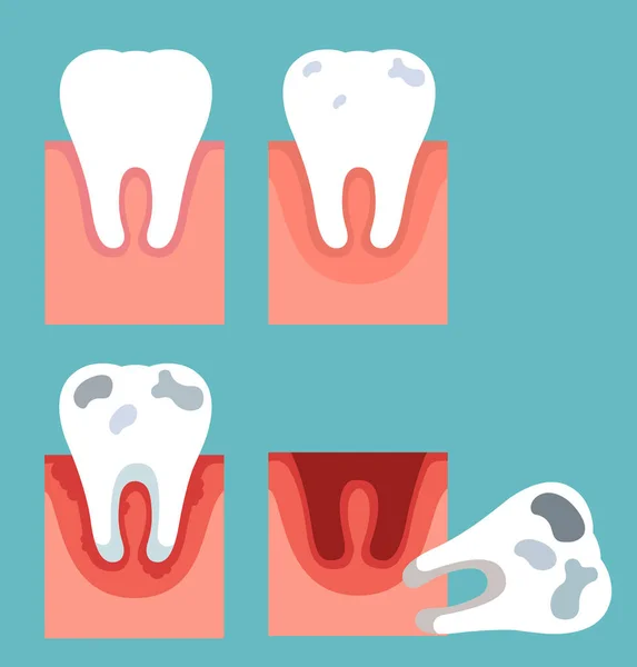 Estágios de cárie dentária —  Vetores de Stock