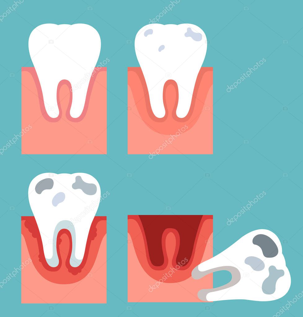 Stages of tooth decay