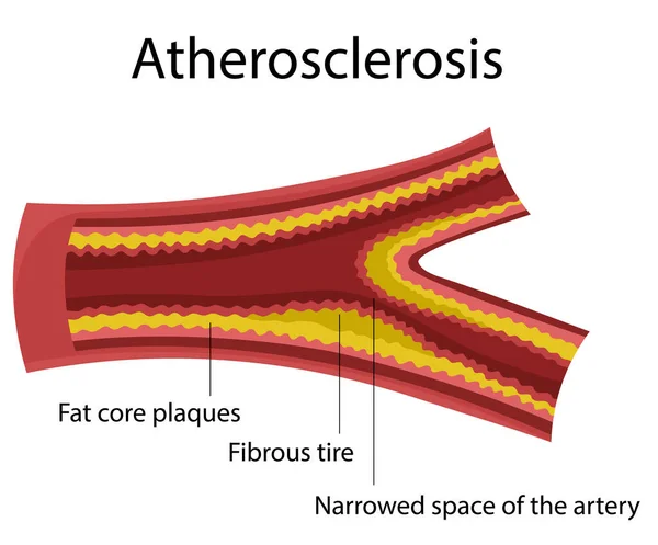 Atherosklerose. Herzkrankheiten lizenzfreie Stockvektoren