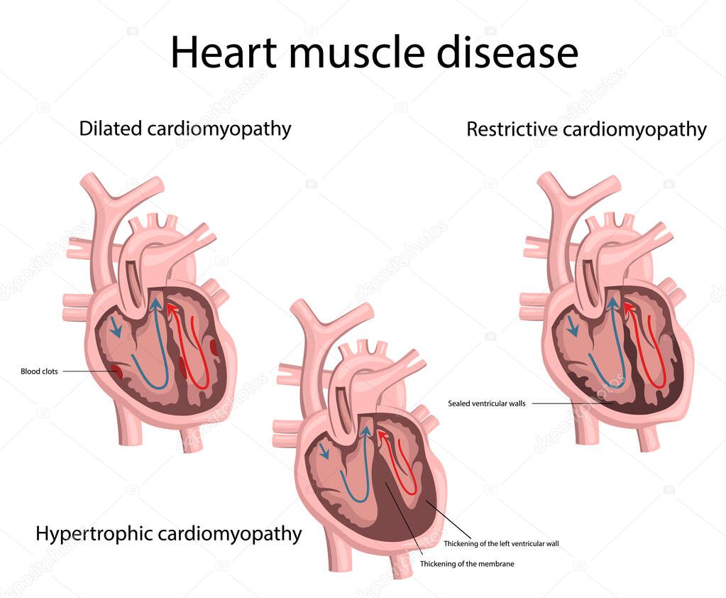 Vector illustration of heart muscle disease. Medicine. 