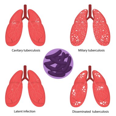 Tüberküloz. Mycobacterium tüberkülozu