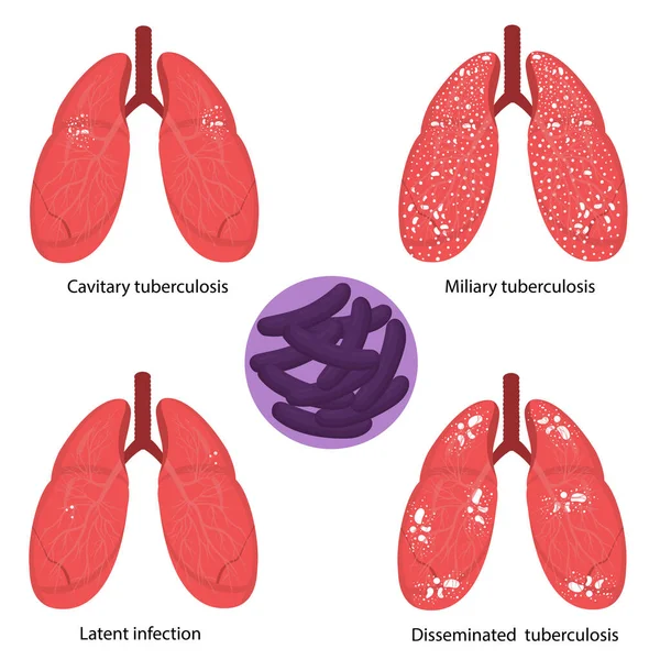 Tuberkulos. Mykobakteriell tuberkulos — Stock vektor