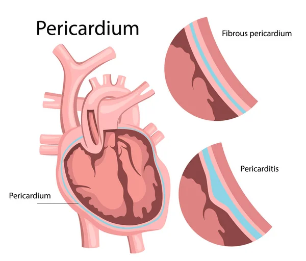 Inflammation i hjärtsäcken. Hjärtsjukdom — Stock vektor