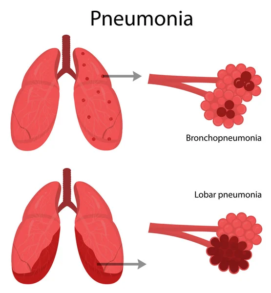 Enfermedad pulmonar. Neumonía. — Archivo Imágenes Vectoriales