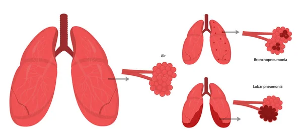 Malattie dell'apparato respiratorio — Vettoriale Stock