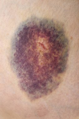 Çürük. Büyük çürük. Enjeksiyon çürükler. Doktor ve hasta. Bruised yaralanma yara ve cilt bereli