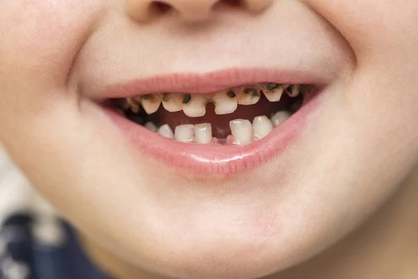 Пациент Открытым Ртом Кариес Разлагается Закрыть Нездоровые Молочные Зубы Зубная — стоковое фото