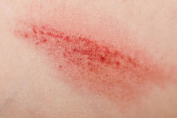 A wound on the human body. Very close up of painful wound — Stock Photo, Image