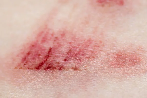 Una herida en el cuerpo humano. Muy cerca de la herida dolorosa —  Fotos de Stock