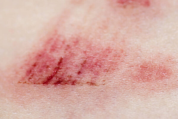A wound on the human body. Very close up of painful wound