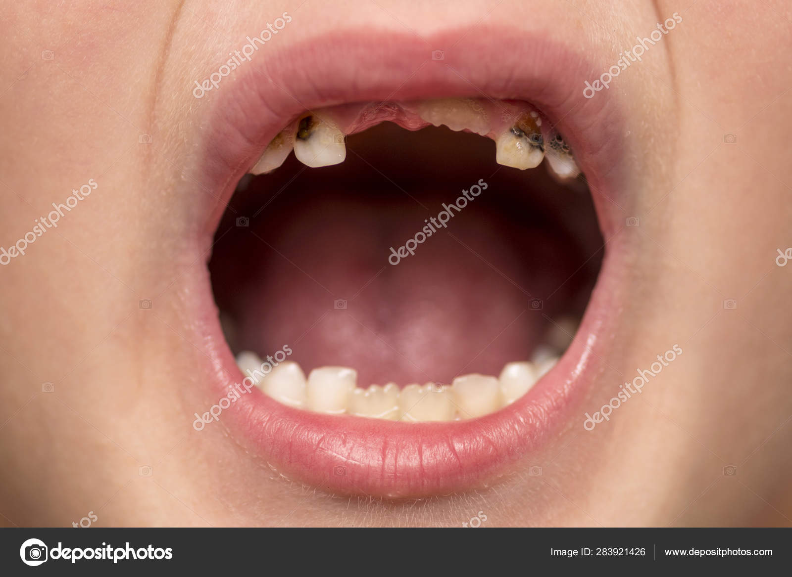 Cavity Two Year Old Teething Epstein Pearls In Newborns: What