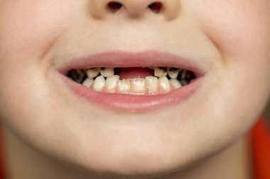 Çürük diş çürümesi gösterilen çocuk hasta açık ağız. Sağlıksız bebek dişlerin kapatın. Diş Hekimliği ve sağlık - insan hasta çürük diş çürümesi gösterilen ağız açın