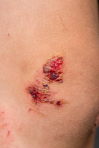 Rasguños Profundos Piel Con Moretones Rodilla Los Niños Heridas Arañazos — Foto de Stock