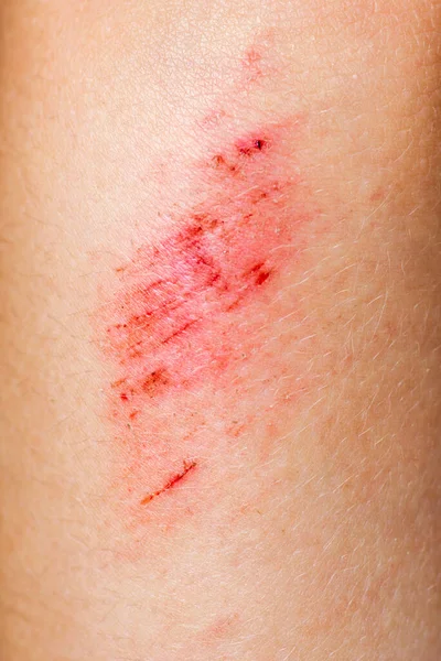 Wounds on the skin. Deep scratches on the skin. Wounds, scratches and abrasions on skin.