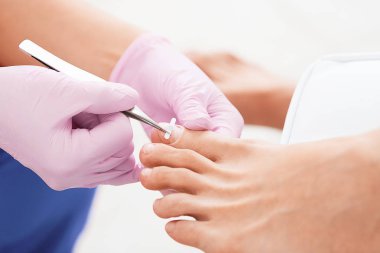 Profesyonel pedikür yapışkanlı düzeltici ayraç kullanarak. Hasta ziyaret ayak hastalıkları uzmanı. Tırnak düzeltme. Ayak tedavi Spa salonda. Podiatry Kliniği.