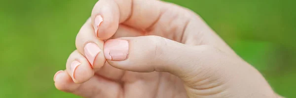 Gebrochener Nagel Auf Weiblicher Hand Mit Rosa Maniküre Auf Grünem — Stockfoto