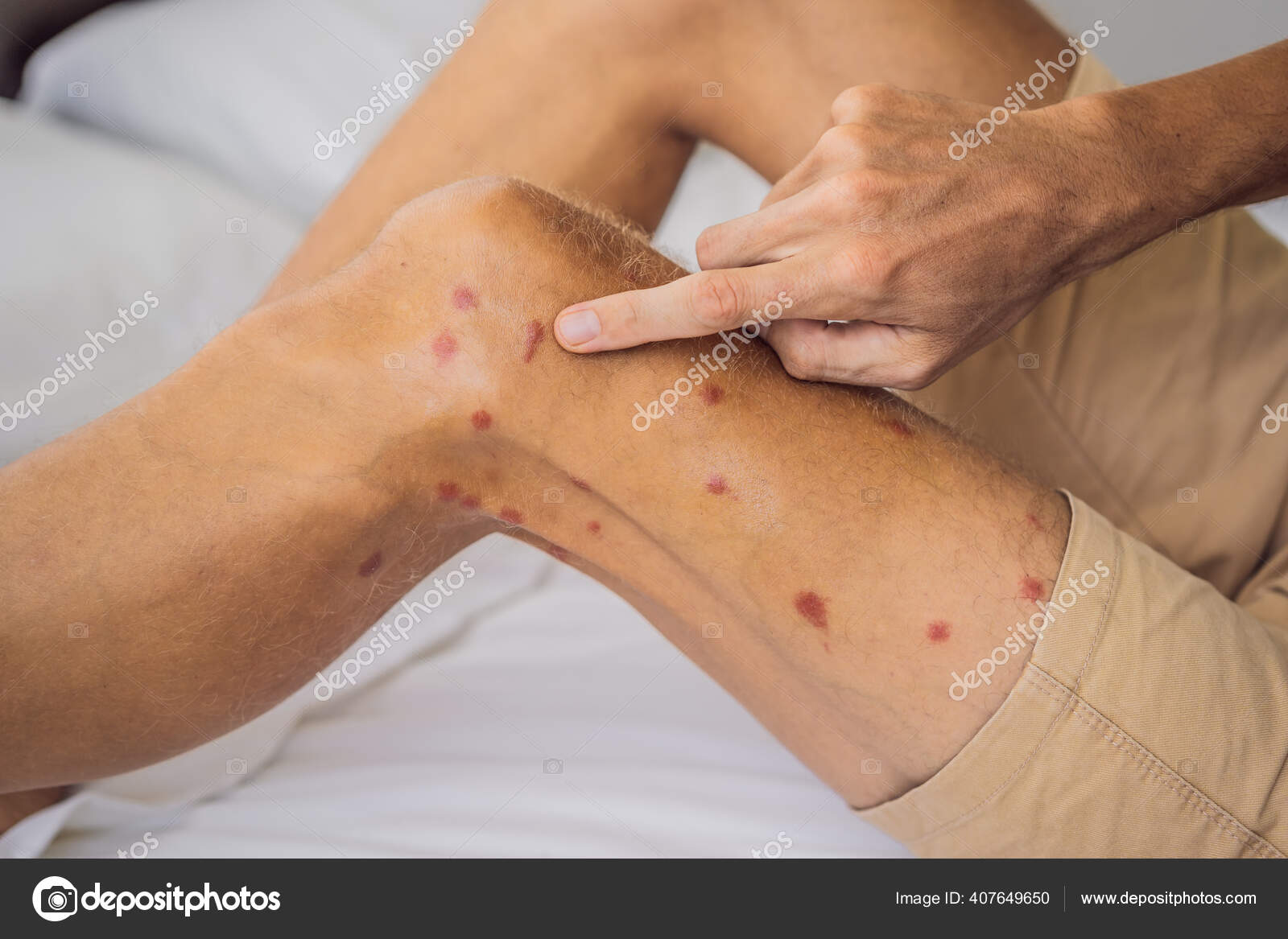 腿上有许多红斑和昆虫叮咬留下的疤痕.蚊子对过敏。沙蝇叮咬——图库图片© galitskaya #407649650, image size:1600x1167