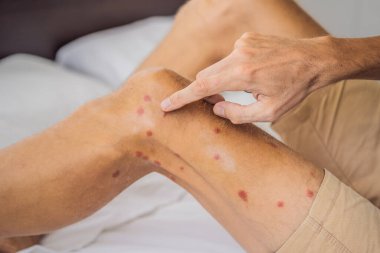 Kırmızı lekeli bacakları ve böcek ısırığından kalma yara izleri var. Sivrisinek alerjisi. Kum sineği ısırır.