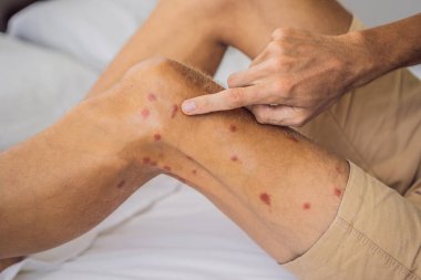 Kırmızı lekeli bacakları ve böcek ısırığından kalma yara izleri var. Sivrisinek alerjisi. Kum sineği ısırır.