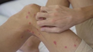 Yatakta oturmuş bacaklarını kaşıyan bir adam. Sivrisinekler ya da diğer ısıran böcekler tarafından ciddi şekilde ısırıldı.